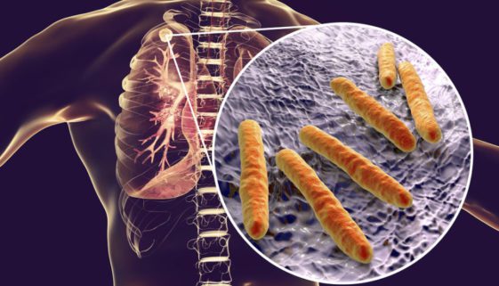 Ermittlungen nach Infektionsschutzgesetz - Erkrankte ist selbst zu befragen